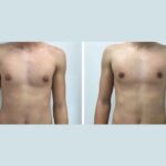 Get a Masculine Silhouette with the Best Gynecomastia Doctors in Dubai