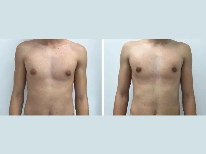 Get a Masculine Silhouette with the Best Gynecomastia Doctors in Dubai