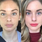 Radiofrequency (RF) Microneedling Treatments for Wrinkles by Best Plastic Surgeon in Dubai