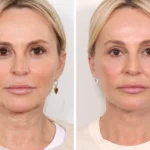 Regain Youthful Skin Easily Through Thread Lift Treatments in Dubai