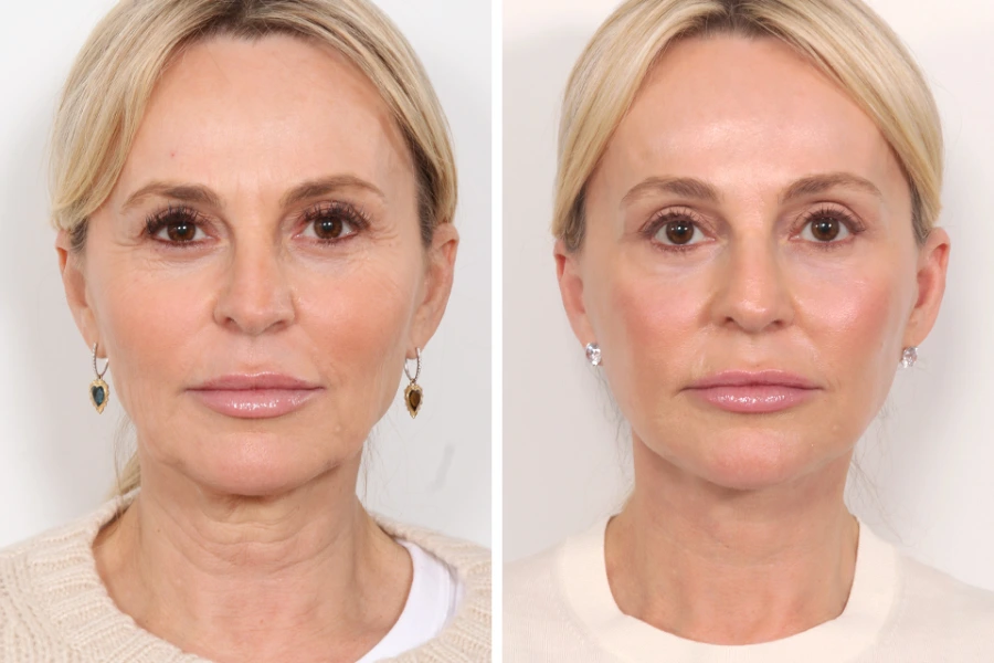 Regain Youthful Skin Easily Through Thread Lift Treatments in Dubai