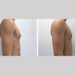 Precision-Based Gynecomastia Surgery in dubai
