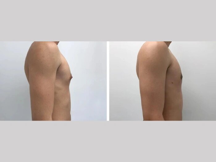 Precision-Based Gynecomastia Surgery in dubai