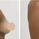 Breast Lift in Dubai