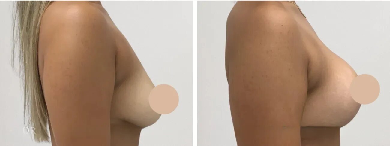 Breast Lift in Dubai