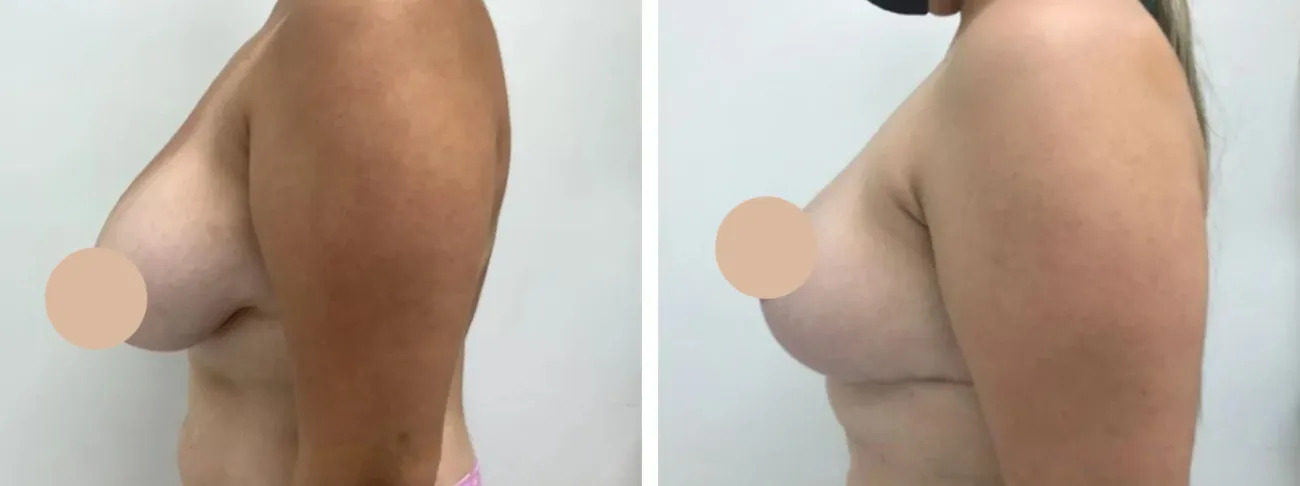 breast reduction in Dubai