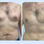 The Role of the Best Doctors in Dubai in Managing Gynecomastia Recovery