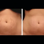 Youthful Skin Solutions with RF Microneedling by Best Plastic Surgeon in dubai