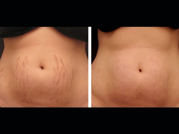 Youthful Skin Solutions with RF Microneedling by Best Plastic Surgeon in dubai