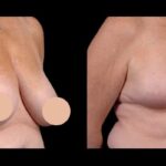 Advanced Breast Reduction Methods in Dubai