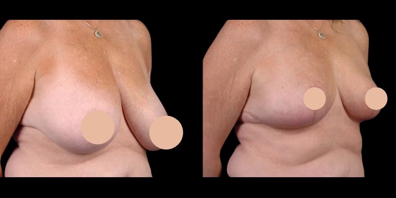 Advanced Breast Reduction Methods in Dubai