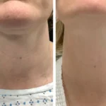 Youthful Skin Is Possible with Radiofrequency (RF) Microneedling in Dubai