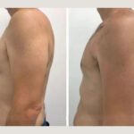 gynecomastia in dubai