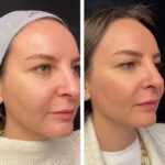 mesotherapy in dubai