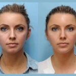 Restore Youthful Volume Effortlessly Through a Reliable Thread Lift in Dubai