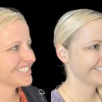 Erase Wrinkles Effortlessly with Botox in Dubai