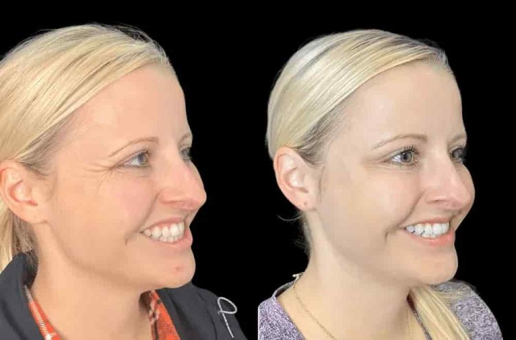 Erase Wrinkles Effortlessly with Botox in Dubai