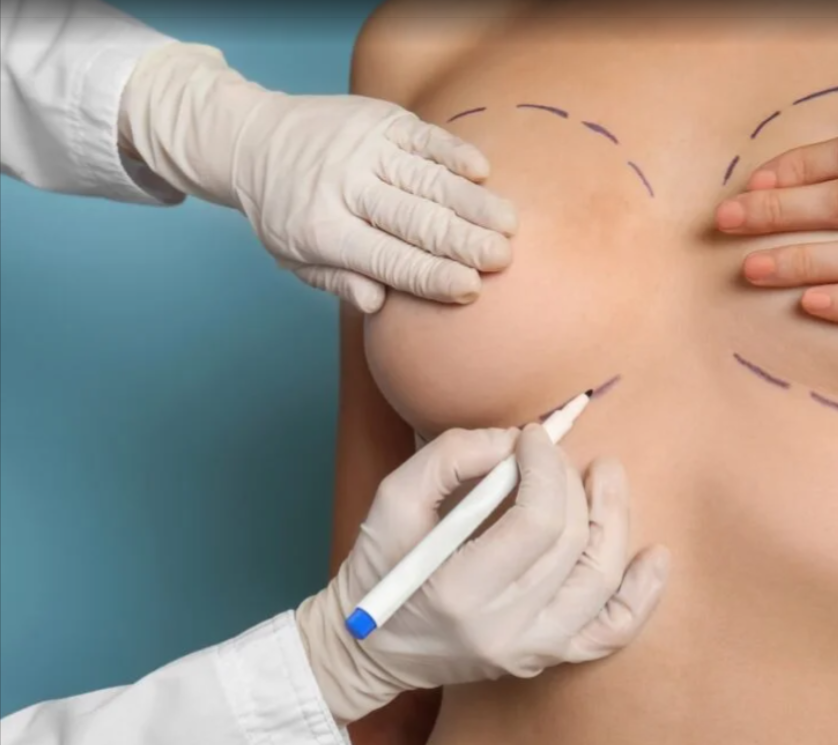 MIA Breast Implant in Dubai – Trusted by Locals and Expats