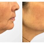 Best Aesthetic Clinics in Dubai for Natural-Looking Thread Lift Results