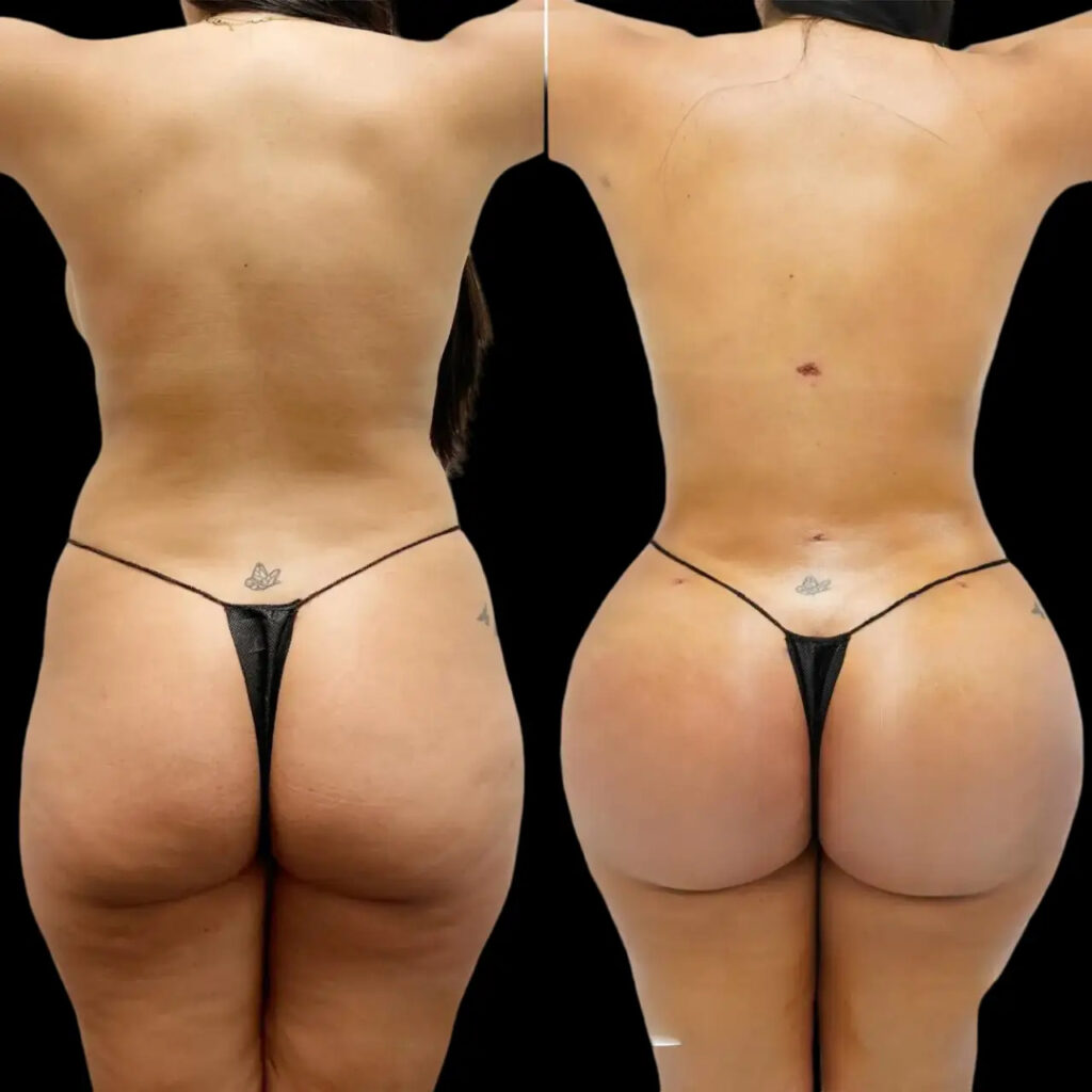 Butt Fat Transfer in dubai