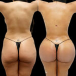 Butt Fat Transfer in dubai