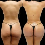 Butt Fat Transfer in Dubai