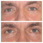 Eye bag removal in Dubai