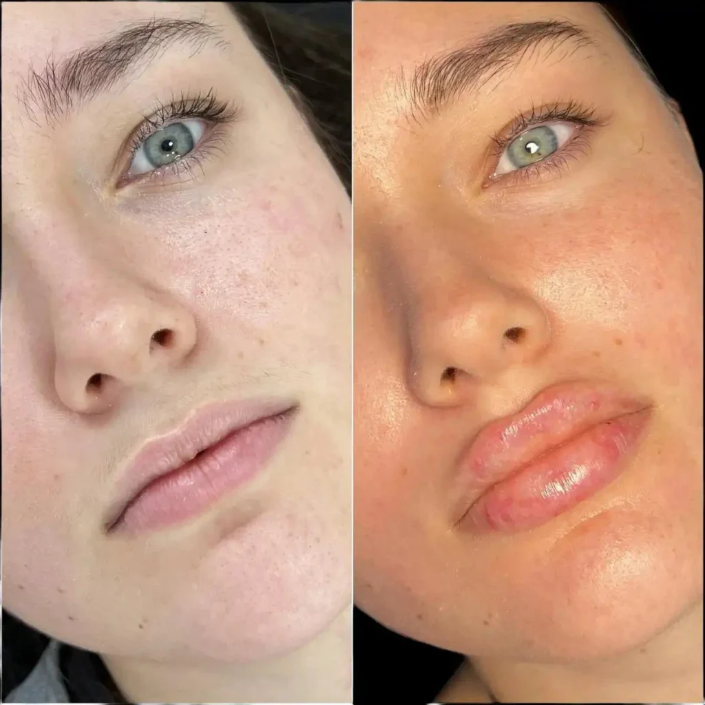 Fillers in Dubai