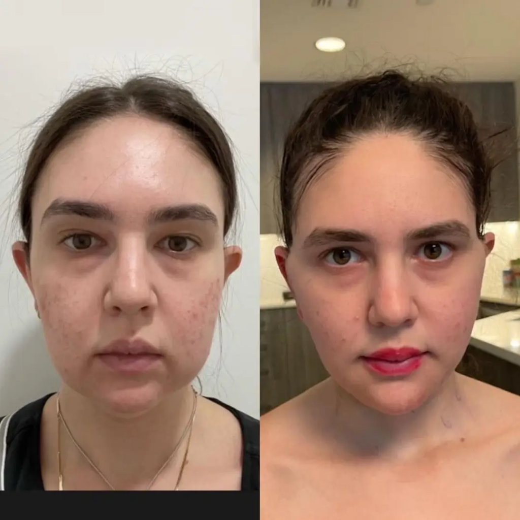 Buccal fat removal in Dubai