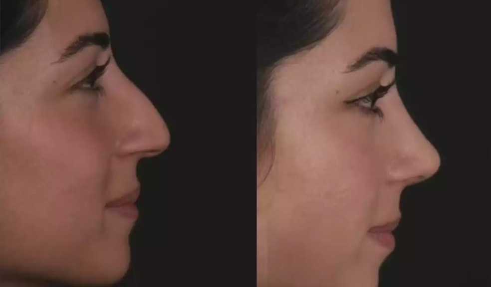 Septoplasty in Dubai