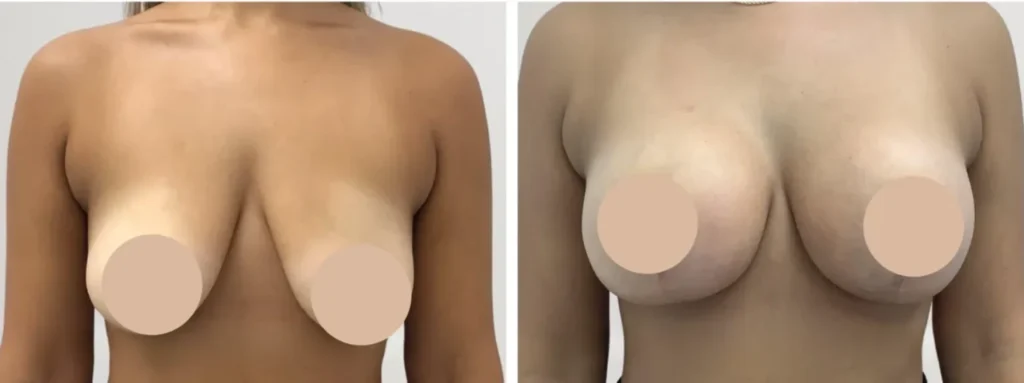 Breast lift in Dubai