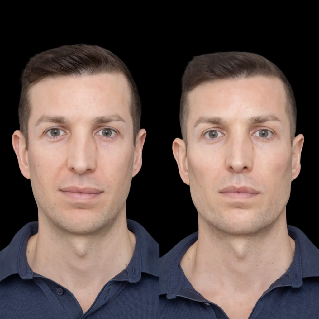 Jawline Fillers in Dubai