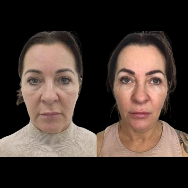 Profhilo in Dubai
