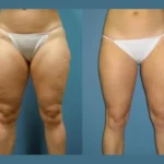 Radiofrequency (RF) Microneedling in Dubai