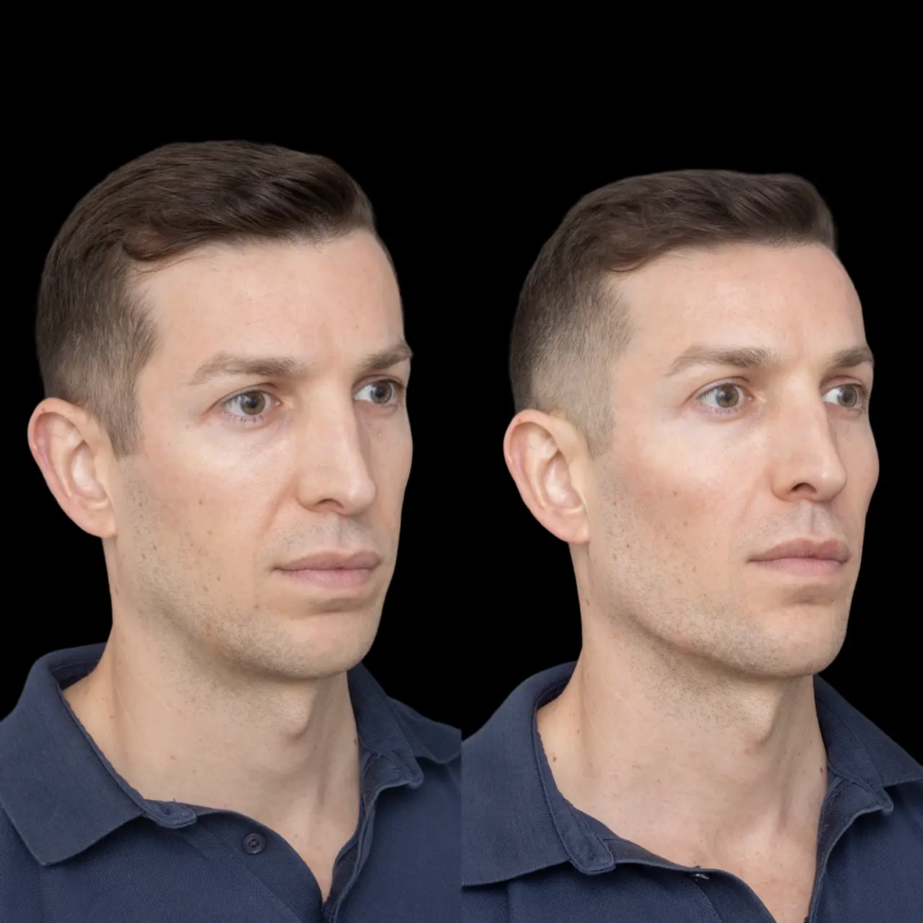 Jawline Fillers in Dubai