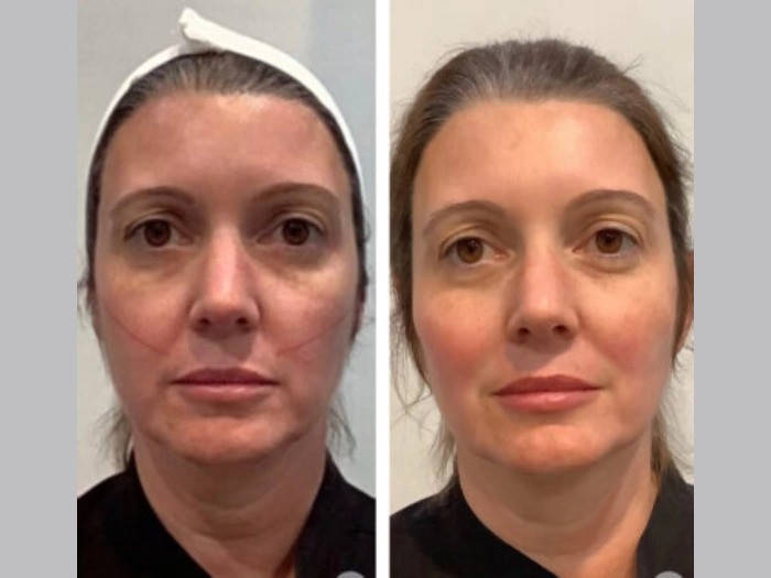 Thread Lift Expertise Trusted Across by Best Plastic Surgeon in Dubai