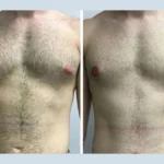 Gynecomastia in Dubai: Why Early Action Leads to Better Outcomes