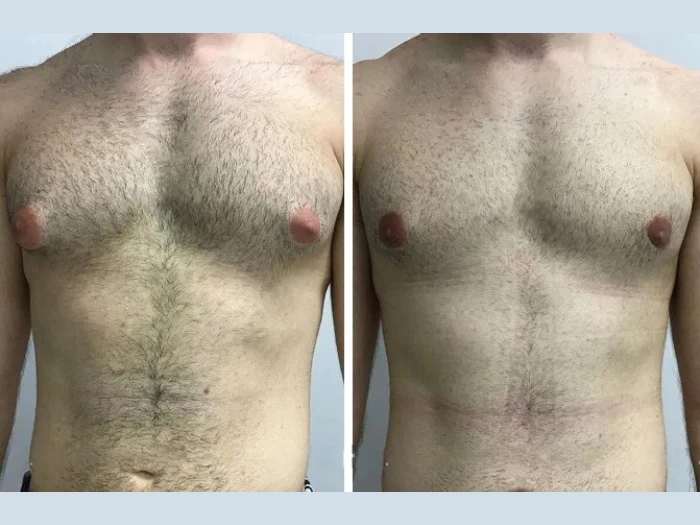 Gynecomastia in Dubai: Why Early Action Leads to Better Outcomes