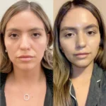 Thread Lift Helps Reduce Sagging Skin and Fine Lines at Best Aesthetic Clinics in Dubai