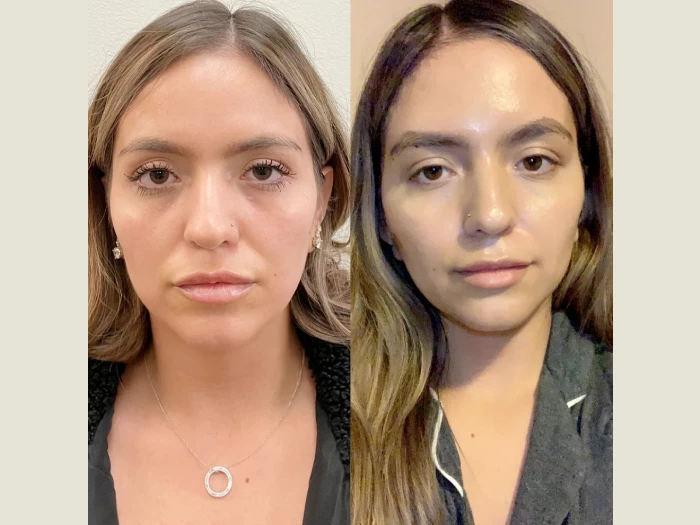 Thread Lift Helps Reduce Sagging Skin and Fine Lines at Best Aesthetic Clinics in Dubai