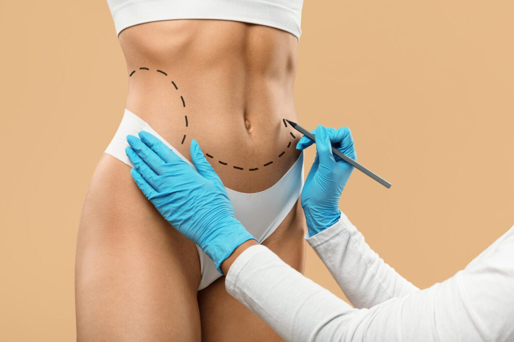best tummy tuck Dubai