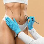 best tummy tuck Dubai