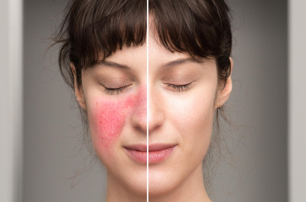 Clearer Skin with Rosacea Treatment in Manchester