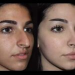 Septoplasty in Dubai