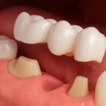 Dental Crown Dubai