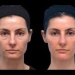 Eyelid Bag Surgery Dubai