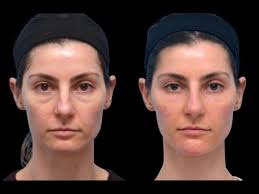 Eyelid Bag Surgery Dubai