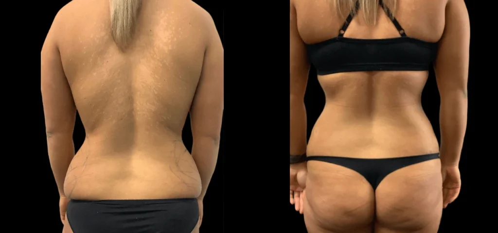 Butt Fat Transfer in Dubai