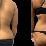 Butt Fat Transfer in Dubai