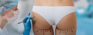 Butt Fat Transfer in Dubai